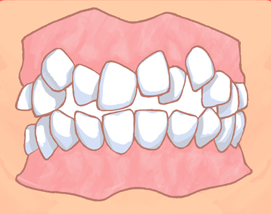 叢生（乱ぐい歯・八重歯）