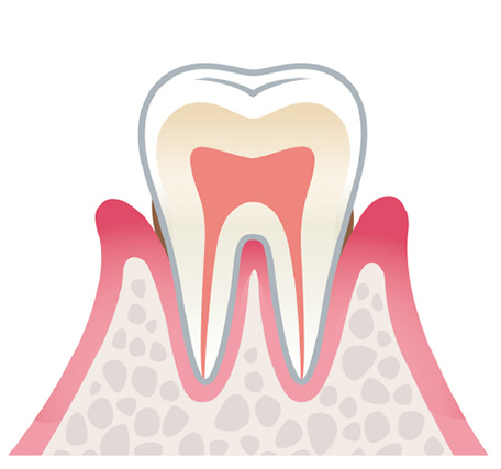 軽度歯周病