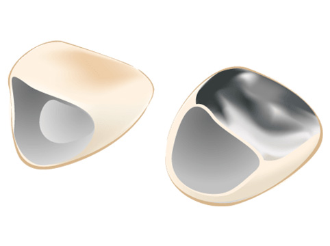 硬質レジン前装冠