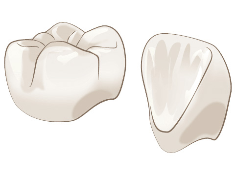 オールセラミッククラウン