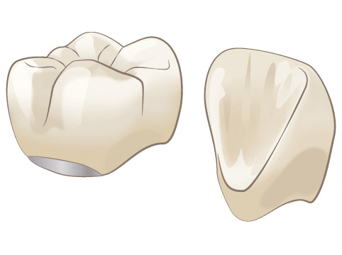 メタルボンドセラミッククラウン