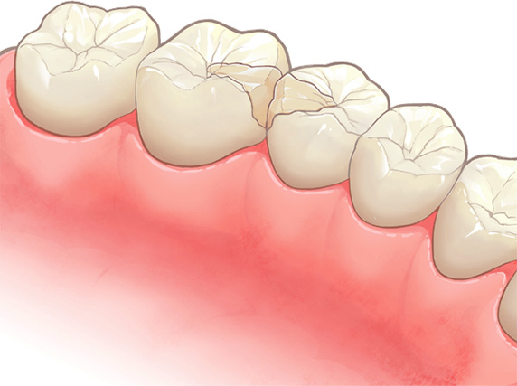 コンポジットレジンインレー
