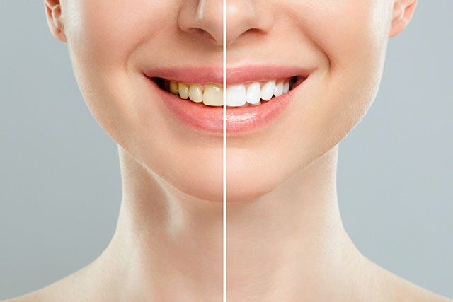 ホワイトニング